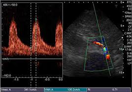 Protegido: Ecografía Doppler en el estudio renovascular
