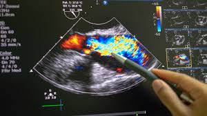 Ecografía doppler
