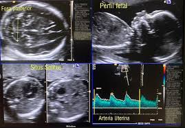 Protegido: Ecografía obstétrica morfo anatómica del II y III trimestre