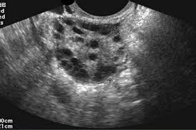 Protegido: Ecografía de ovarios normal
