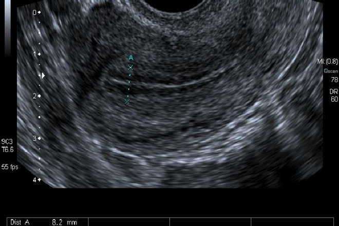 Protegido: Ecografía normal de endometrio