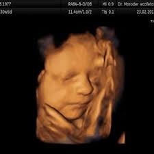 Protegido: Ecografía de rostro fetal: órbitas, hueso nasal, labios y cristalino parrafo