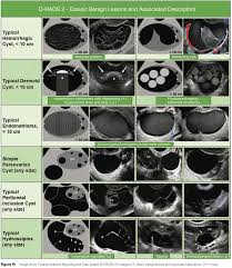 CLASE 8 CLASIFICACION IOTA TUMOR BENIGNO DE OVARIOS