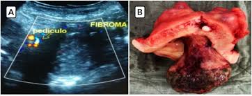CLASE 6 MIOSARCOMA ADENOMIOSIS VARICES UTERINAS Y PATOLOGIA ENDOMETRIAL POR ECO