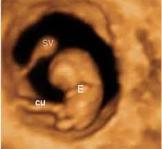 CLASE 11 ECOGRAFIA OBSTETRICA EN EL PRIMER TRIMESTRE