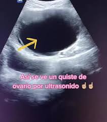 clase 9 tu benignos de ovarios