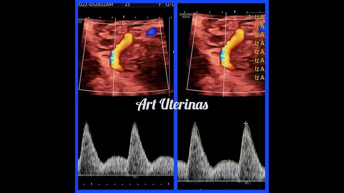 FLUXOMETRIA DOPPLER DE ARTERIAS UTERINAS