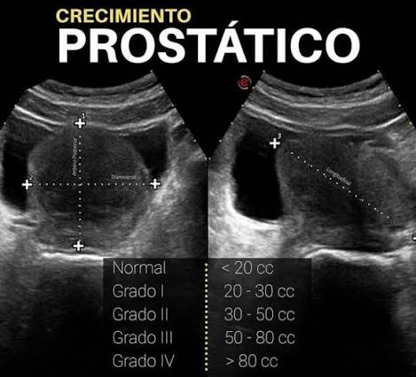 CLASE 34 ECOGRAFIA DE PROSTATA Y VEJIGA NORMAL Y PATOLOGICA