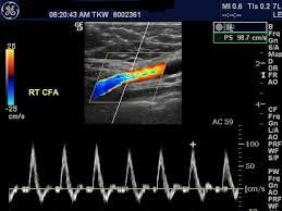 CLASE 43 ECOGRAFIA DOPPLER ARTERIAL DE EXTREMIDAD INFERIOR