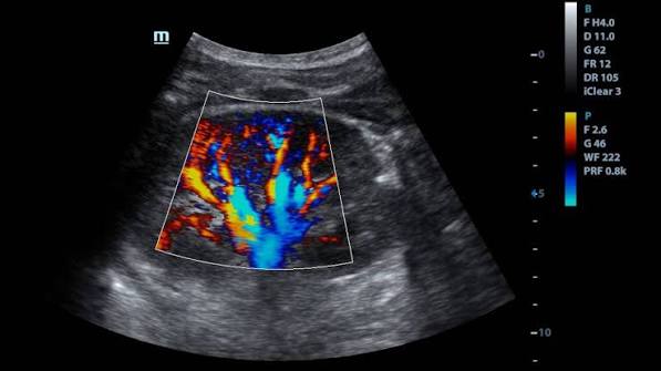 CLASE 41 ECOGRAFIA DOPPLER RENAL