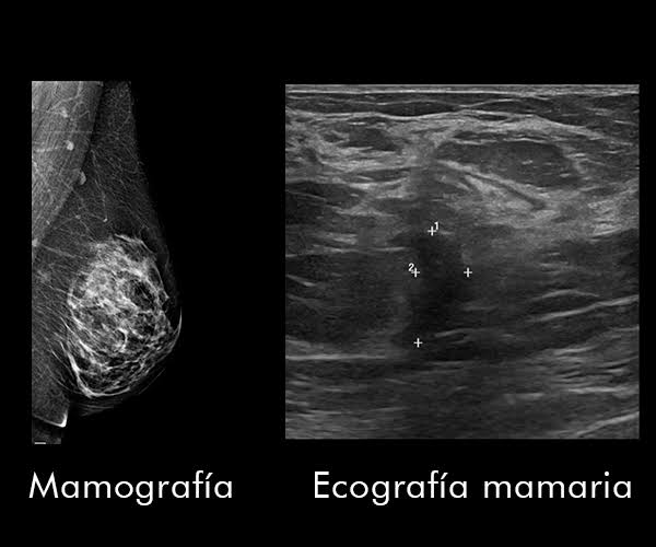 Nuevo cursoCLASE 38 ECO MAMARIO PATOLOGICO ECO BIRADS